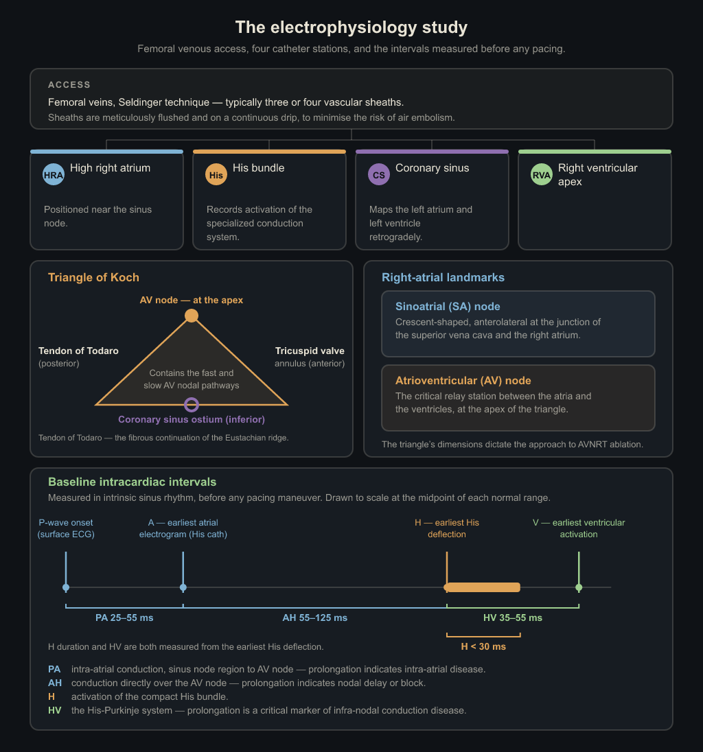 Layout of an electrophysiology study: femoral venous access feeding four catheter stations — high right atrium, His bundle, coronary sinus and right ventricular apex — the Triangle of Koch, and a to-scale timeline of baseline intervals PA, AH and HV.