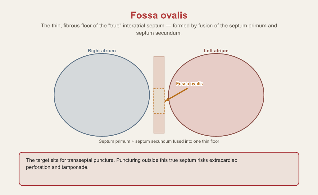Right and left atria separated by the interatrial septum with the fossa ovalis marked as the thin fibrous floor formed by fusion of the septum primum and septum secundum — the target site for transseptal puncture.