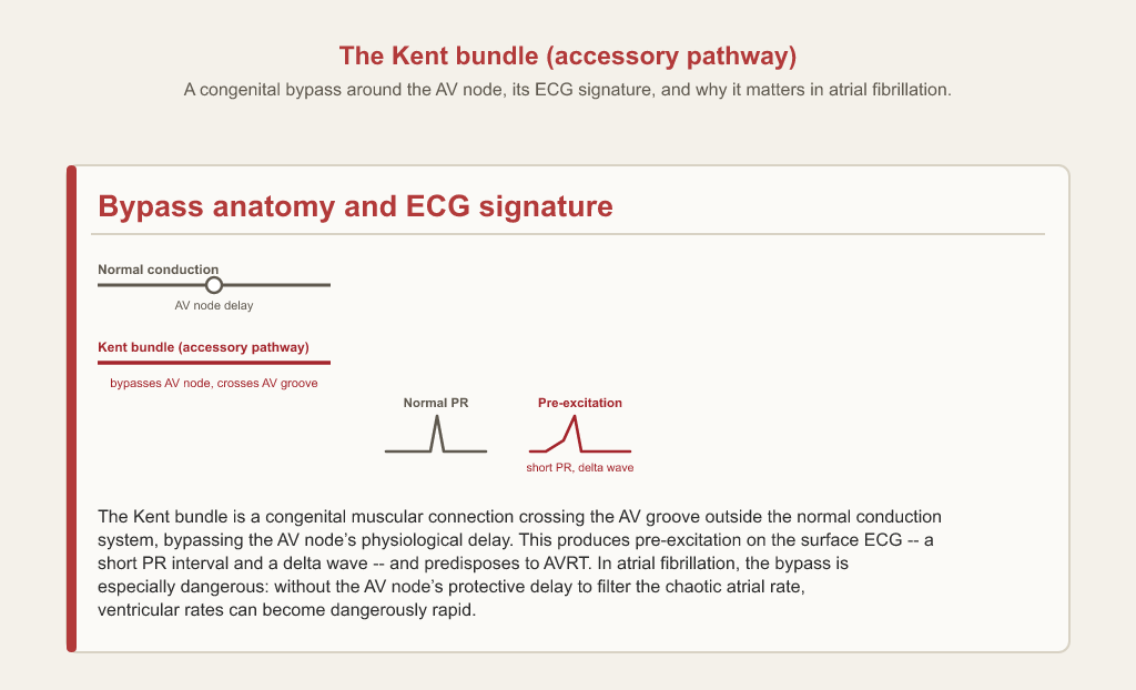 Normal conduction shown delayed at the AV node compared with a Kent bundle bypassing it across the atrioventricular groove, and the resulting ECG change from a normal PR interval to a short PR interval and delta wave.