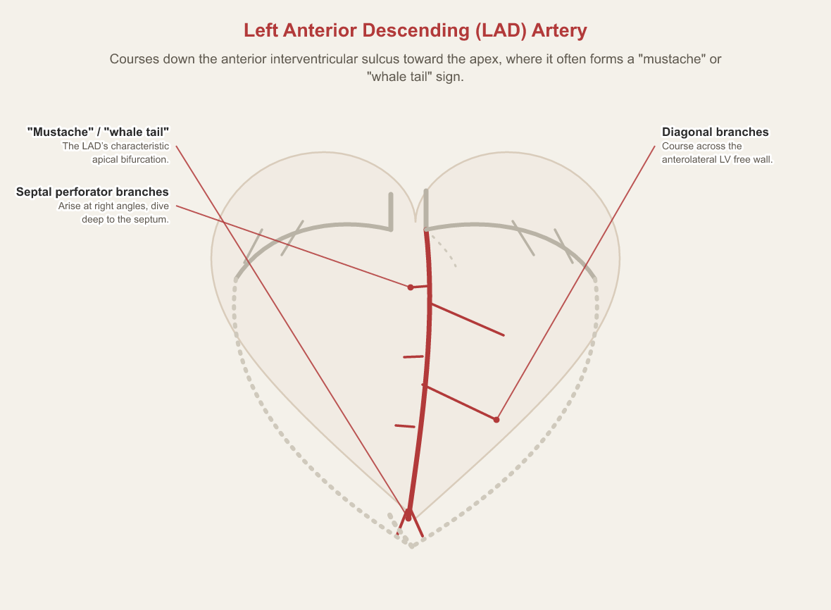 Anterior view of the heart with the left anterior descending artery highlighted running down the anterior interventricular sulcus toward the apex, labelling septal perforator branches, diagonal branches crossing the anterolateral left ventricular free wall, and the apical wrap known as the mustache or whale-tail sign.