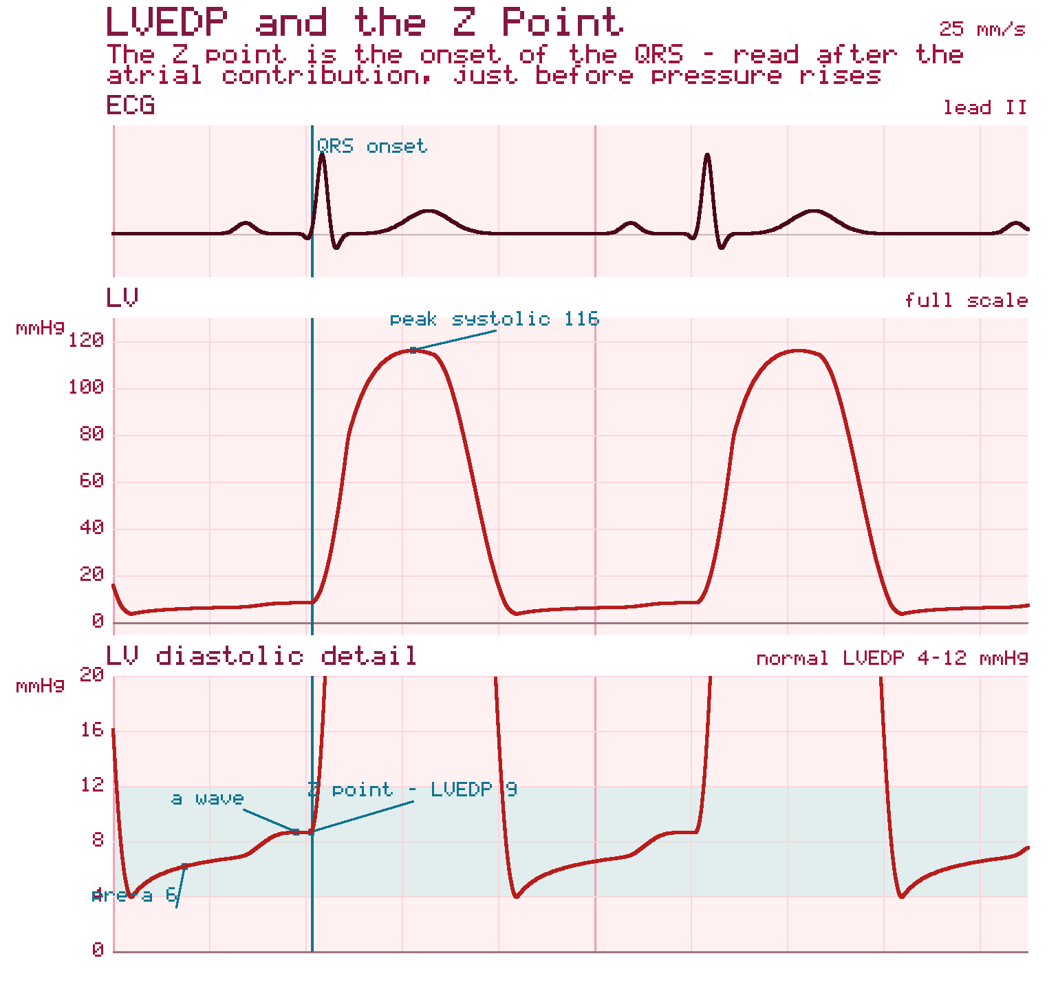 Three stacked tracings: a lead II ECG with QRS onset marked, a full-scale left ventricular pressure curve, and a magnified LV diastolic tracing marking the a wave and the Z point at QRS onset where LVEDP is read.