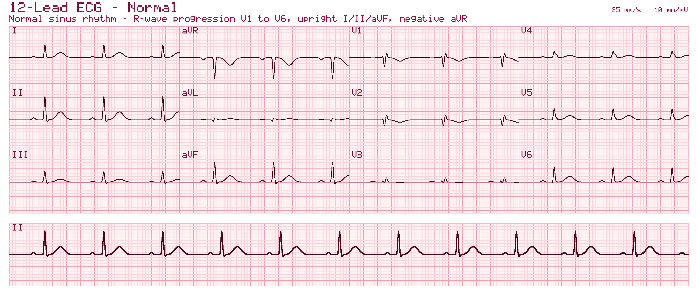Normal 12-lead ECG recorded at 25 mm per second showing sinus rhythm, upright complexes in leads I, II and aVF, a negative complex in aVR, and progressive R-wave growth from V1 through V6, with a lead II rhythm strip along the bottom.