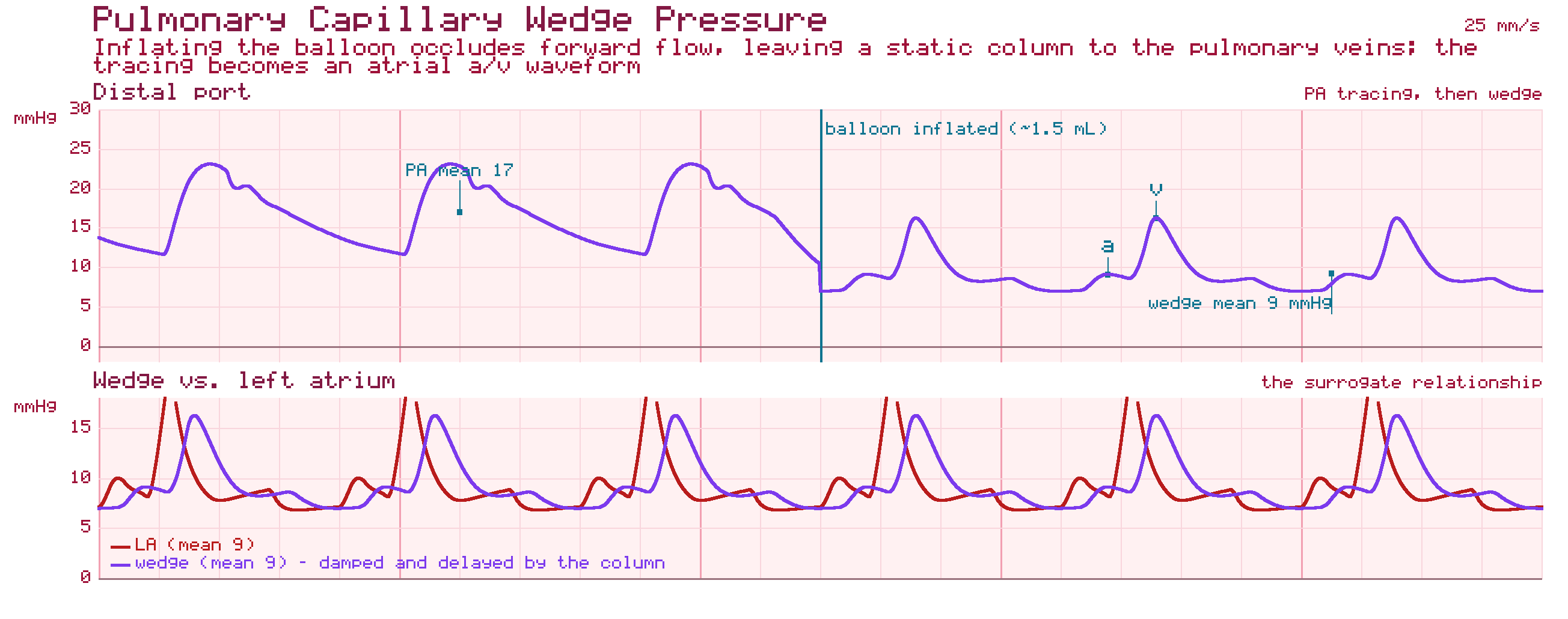 Pulmonary capillary wedge pressure tracing: a pulmonary artery waveform damping into a wedge a/v waveform once the balloon is inflated, and a second panel overlaying the wedge tracing on a left atrial tracing of the same mean.