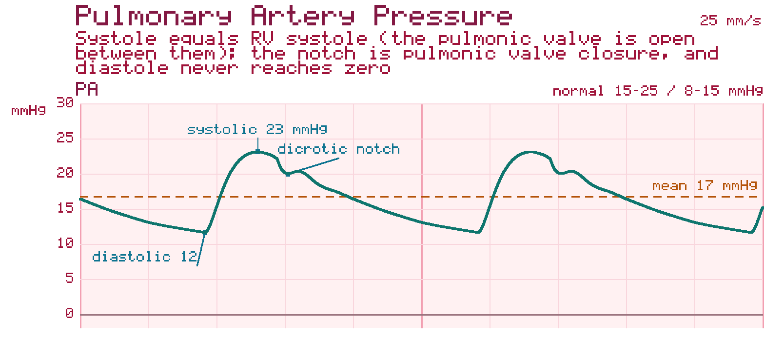 Pulmonary artery pressure tracing with a systolic peak matching right ventricular systole, a dicrotic notch marking pulmonic valve closure, and a diastolic pressure that never falls to zero.