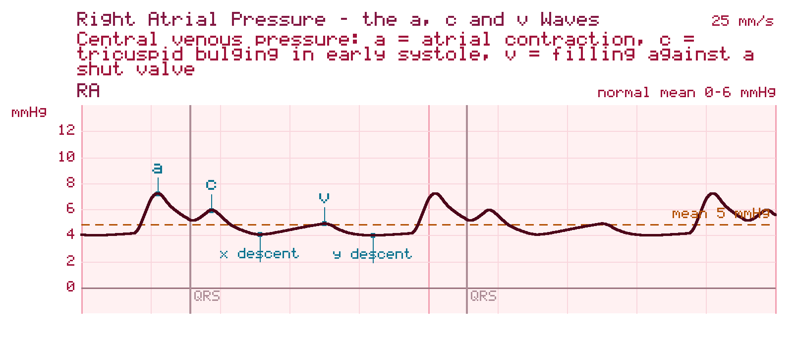 Right atrial pressure tracing showing the a wave of atrial contraction, the c wave of tricuspid bulging in early systole, the v wave of filling against a closed valve, and the x and y descents between them, timed against the QRS.