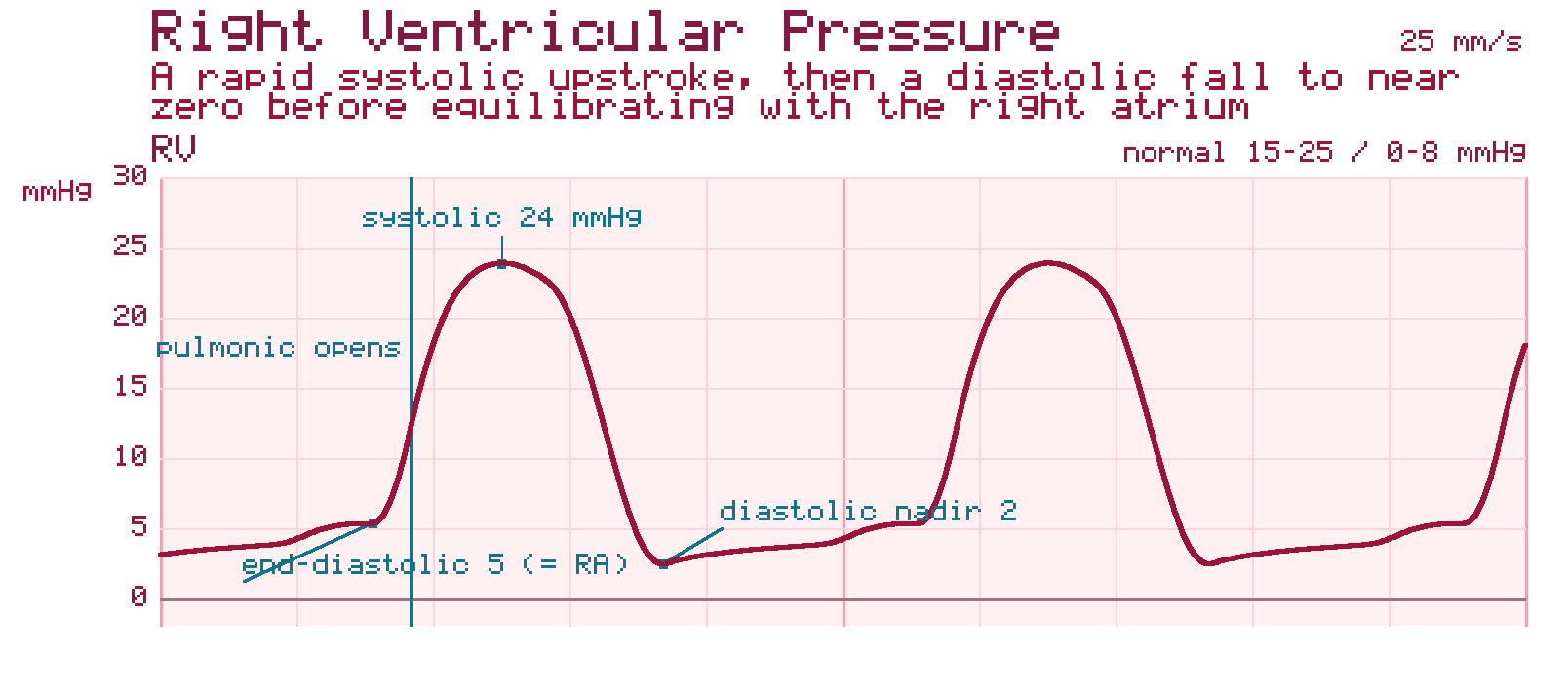 Right ventricular pressure tracing with a rapid systolic upstroke, the point marked where the pulmonic valve opens, a near-zero diastolic nadir, and an end-diastolic pressure equal to the right atrium.